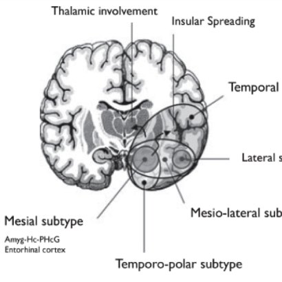 Neurocirugía Del Hospital De La Princesa Electrocorticographic Evidence 