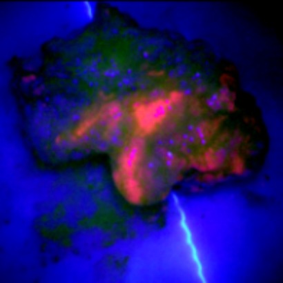 Fluorescencia azul en glioma