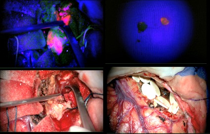 Imágenes intraoperatorias donde podemos observar una foto del tumor con luz azul